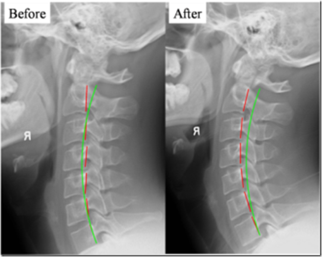 Dr. Adam W. Roussel Cervical Curve and Its Importance